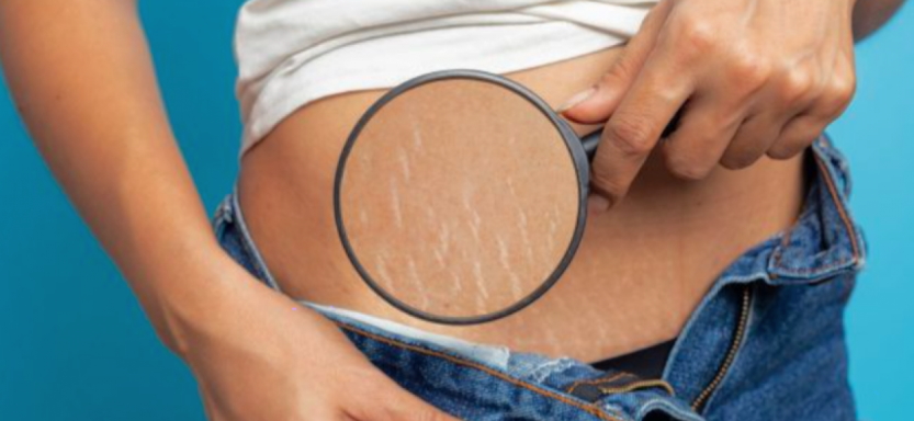 way to prevent stretch marks